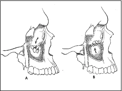 Gambar 7 : A. Fraktur blow-out, B. Fraktur Blow-in (Robert H. Mathog, M.D, Maxillofacial trauma, Williams & Wilkins, 1984:324)  