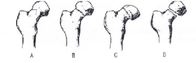Gambar 2. Klasifikasi fraktur collum femoris menurut Garden