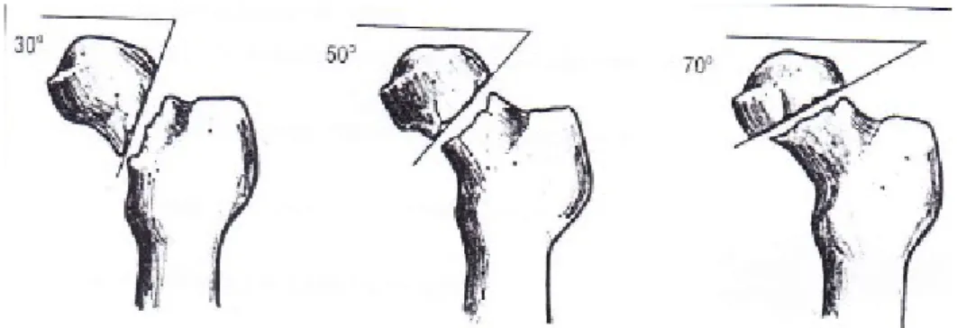 Gambar 3. Klasifikasi fraktur collum femoris menurut Pauwel