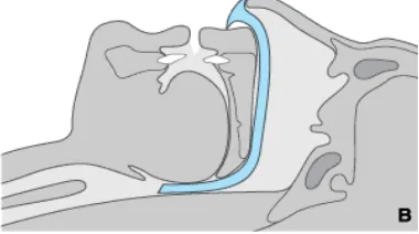 Gambar 2.3. Oropharingeal Airway (sumber : The McGraw-Hill 