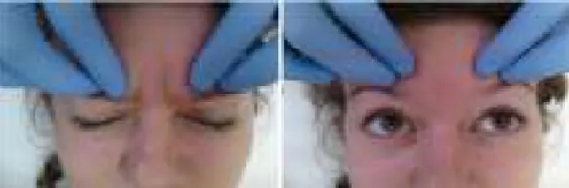 Gambar 1 Stimulasi otot frontalis (Sumber: Sardaru D, Pen- Pen-defunda L. Neuroproprioceptive facilitation in the  re-educa-tion of funcre-educa-tional problems in facial paralysis: a practical  ap-proach