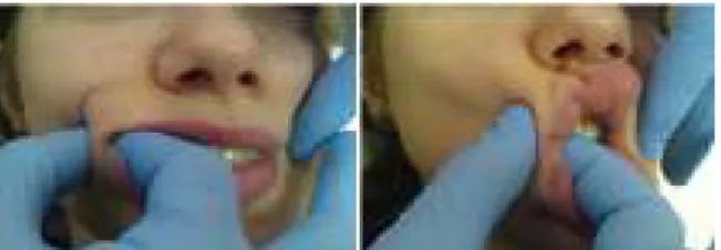 Gambar 5 Stimulasi otot buccinator dan risorius (Sumber: 