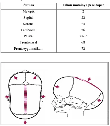 Gambar 2. Gambar  sebelah  kiri  menunjukkan  sagital  synostosis           sebelah kanan terlihat frontal dan occipital bossing