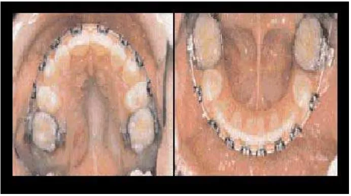 Gambar 22. Foto intra-oral oklusal  menunjukkan  perkembangan  bentuk  lengkung,  