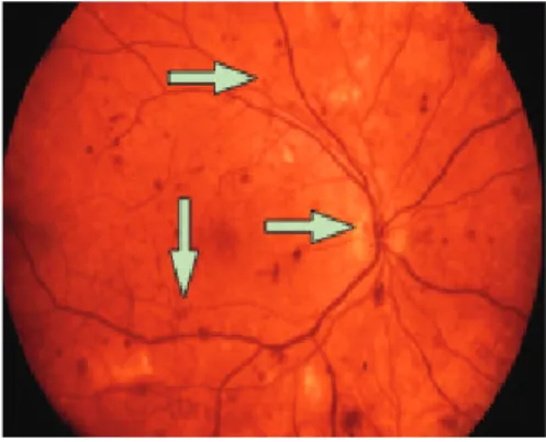 Gambar	 4. Neovaskularisasi pada diabetic  retinopathy tipe proliferatif 17