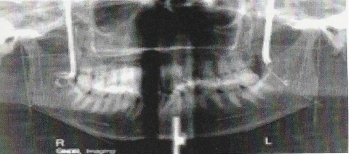 Gambar 3. Gambar panoramic dari tulang tengkorak yang tampak ditempatkan pada   posisi yang bergeser 