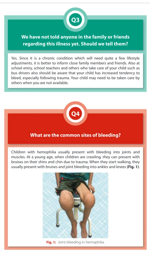 Fig. 1:   Joint bleeding in hemophilia.