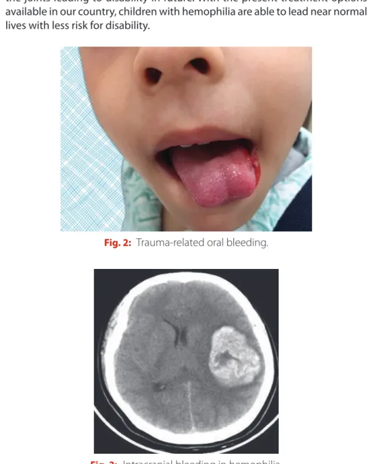 Fig. 2:   Trauma-related oral bleeding.