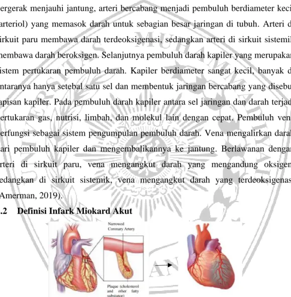 Gambar 2.3 Jantung yang terkena IMA (Gupta et al., 2018) 