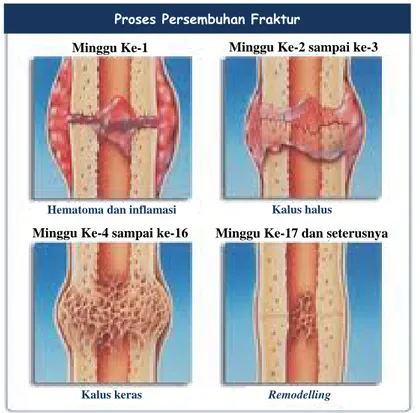 Gambar 6  Proses persembuhan tulang (Anonim 2010). 