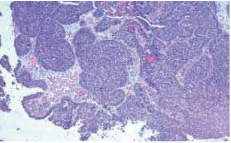 Gambar. 2.2. Karsinoma sel skuamosa, non-keratinizing. kohesif menginvasi ke dalam stroma dibawahnya