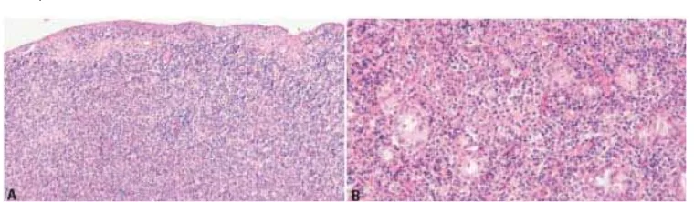 Gambar 2.3. Nasal NK/T cell lymphoma. A. Mukosa intak dan terlihat sebaran infiltrat sel-sel limfoma