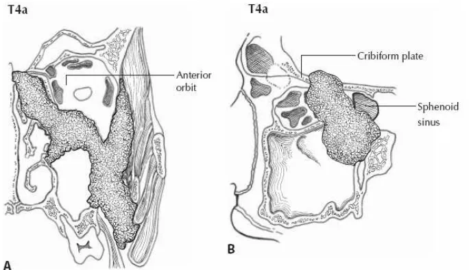 Gambar 2.6. Tumor menginvasi dinding posterior tulang sinus maksilaris, jaringan subkutaneus, dinding dasar dan medial orbita, fossa pterigoid, sinus etmoidalis (Greene, 2006)