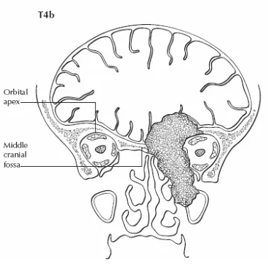 Gambar 2.8. Pandangan koronal T4b menunjukkan tumor menginvasi apeks orbita dan atau dura, otak atau fossa kranial medial (Greene, 2006)