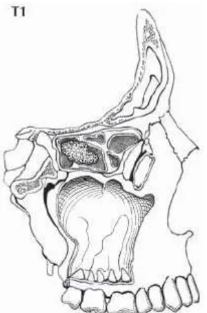 Gambar 2.9. Pada kavum nasi dan sinus etmoidalis, T1 didefinisikan sebagai tumor yang terbatas pada salah satu bagian, dengan atau tanpa invasi tulang (Greene, 2006)