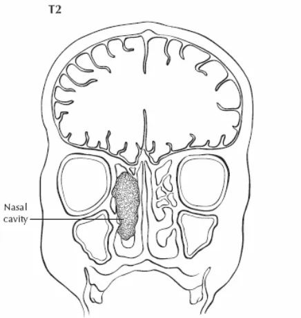 Gambar 2.11. Dua pandangan dari T3 menunjukkan tumor menginvasi sinus maksilaris dan palatum (kiri) dan meluas ke dasar orbita dan fossa kribriformis (kanan) ((Greene, 2006)