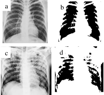 Gambar 1  Hasil proses tresholding (a) Citra paru normal sebelum tresholding, (b) Citra paru normal setelah tresholding, (c) Citra TB paru sebelum tresholding, (d) Citra TB paru setelah tresholding 