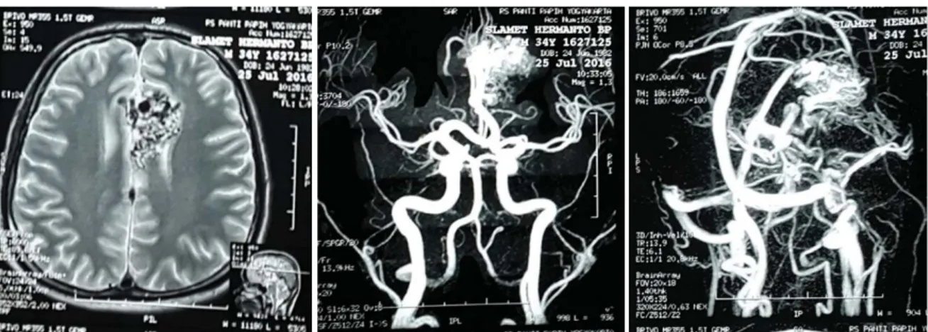 Gambar 2. Konfirmasi dengan cerebral MRA didapatkan gambaran AVM pada lobus  Frontalis kanan dengan feeding dari arteri serebri anterior kanan