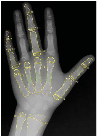 Gambar 2.1. Sinar-X dari pergelangan tangan kiri pasien1 