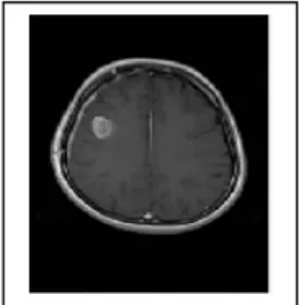 Gambar 1. Citra MRI tumor otak manusia 