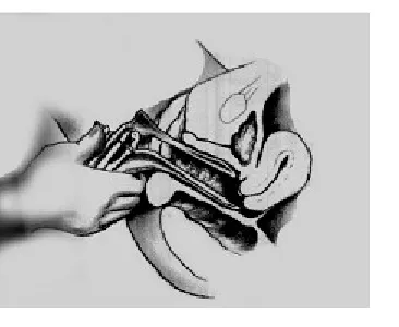 Gambar 12. Setelah mencapai fornix posterior, gagang spekulum diputar tegak lurus searah 