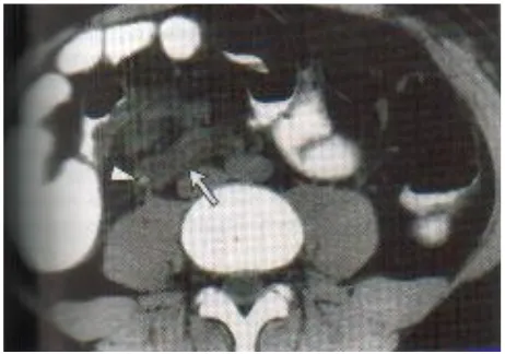 Gambar 3.8. Gambaran CT Scan abdomen: Appendicitis perforata