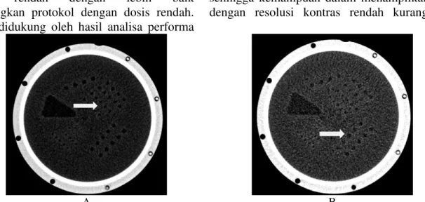 Gambar 2. Citra fantom kontras  rendah; A. dengan protokol dosis tinggi, B. dengan protokol dosis rendah.