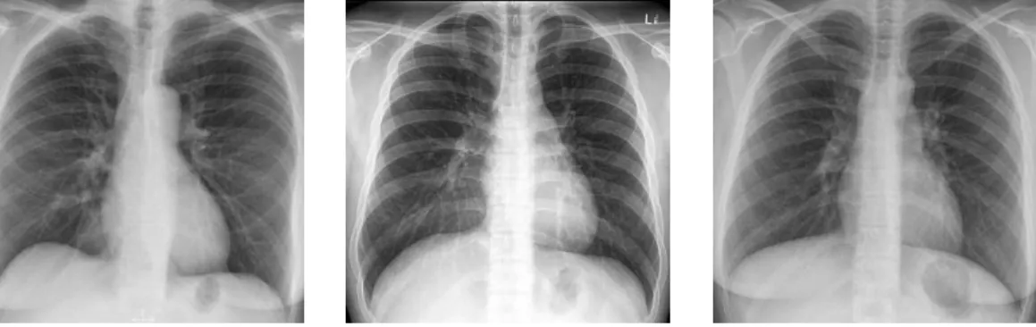 Gambar 2.2. Paru-paru Normal (RSU. Pirngadi, 2017) 