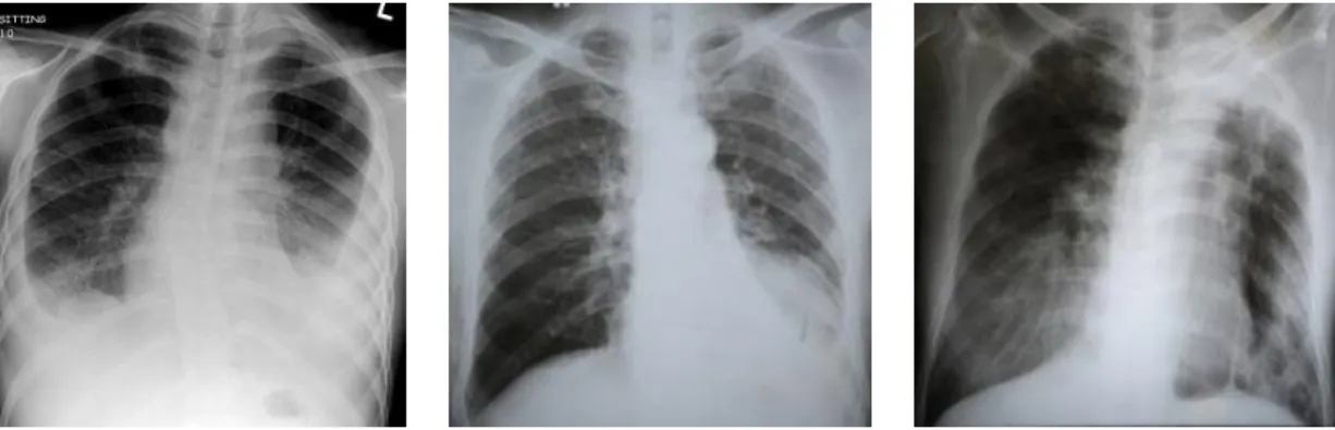 Gambar 2.3. Tuberculosis Primary (RSU. Pirngadi, 2017) 