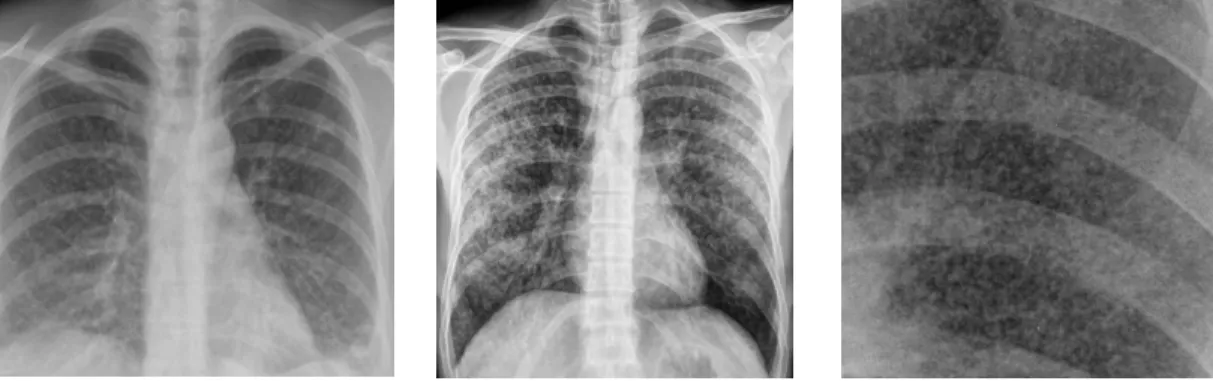Gambar 2.4. Tuberculosis Miliary (RSU. Pirngadi, 2017) 