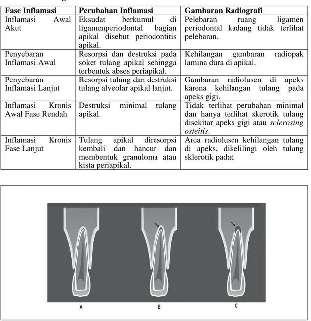 Tabel 1.   Efek proses iflamasi yang berada pada jaringan periapikal dan gambaran   radiografi 11