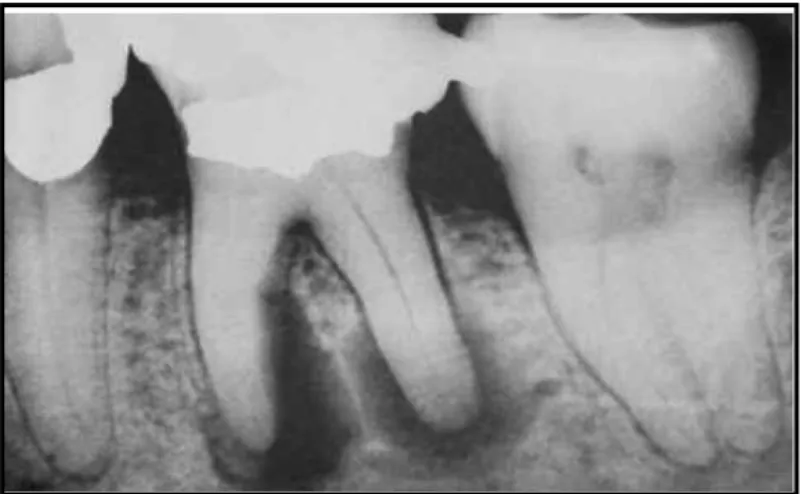 Gambar 5. Gambaran radiografi granulomaperiapikal 14