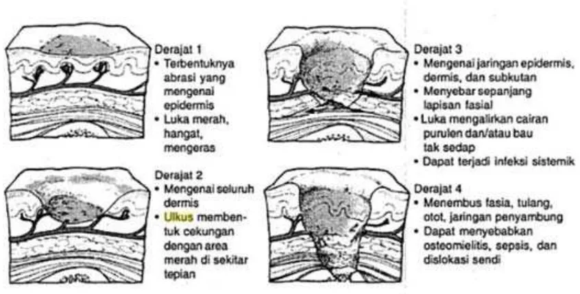 Gambar 2.1 Klasifikasi Ulkus Dekubitus  