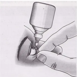 Gambar 2. Pasien harus melihat ke atas untuk mencegah obat  langsung menetes tepat ke kornea, yang akan merangsang pengeluaran  air mata dan menyebabkan delusi obat