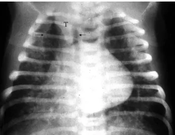Gambar 2.2 Gambaran radiologis menunjukkan aspirasi mekonium yang berat. Gambaran  radiologis diatas menunjukkan perselubungan yang kasar pada parenkim paru dengan  hiperekspansi yang berat