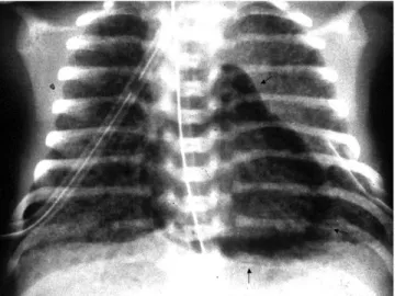 Gambar 2.4 Gambaran radiologis pasien yang diterapi dengan extracorporeal membrane  oxygenation (ECMO)