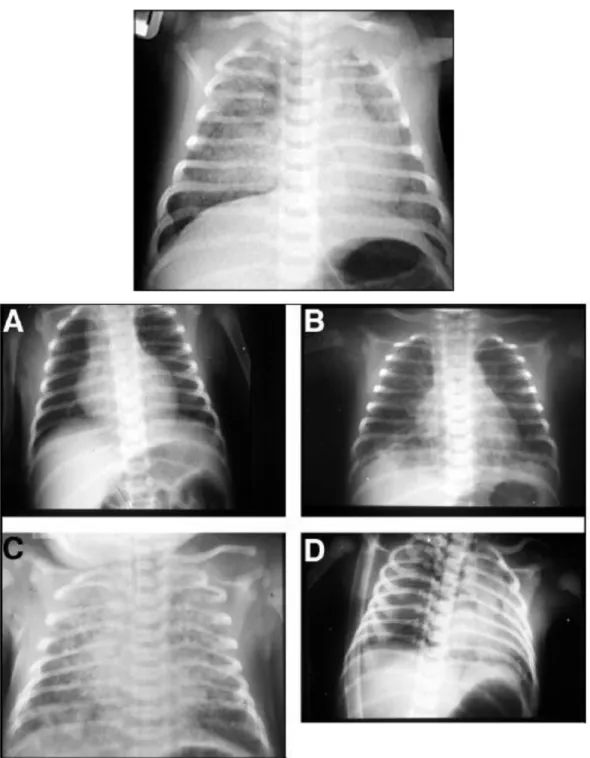 Gambar 2.5 Radiografi dada SAM. A). Infiltrat linear sedang, menandakan aspirasi mekonium  encer dalam jumlah kecil