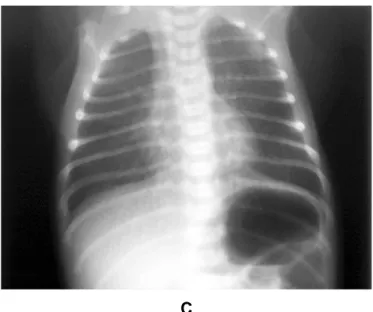 Gambar 2.6 Radiografi dada pada TTN. A). Gambaran radiografi pada neonatus yang berusia 6  jam
