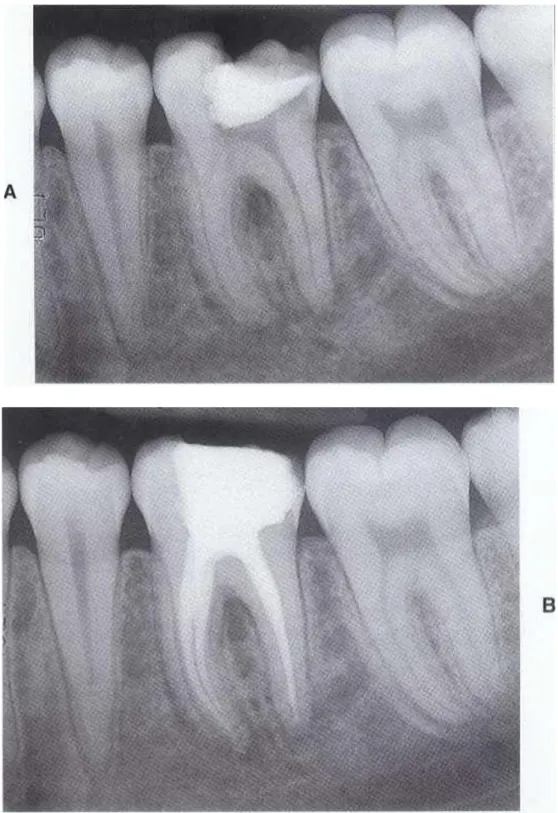 Gambar 3.2. Preoperative (A) dan postoperative (B) radiografi molar  pertama mandibula kanan yang dipreparasi dengan Profile .06 tapered  instruments
