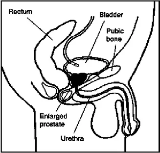Gambar 2.2. Aliran Urin dengan BPH  (NKUDIC, 2006) 