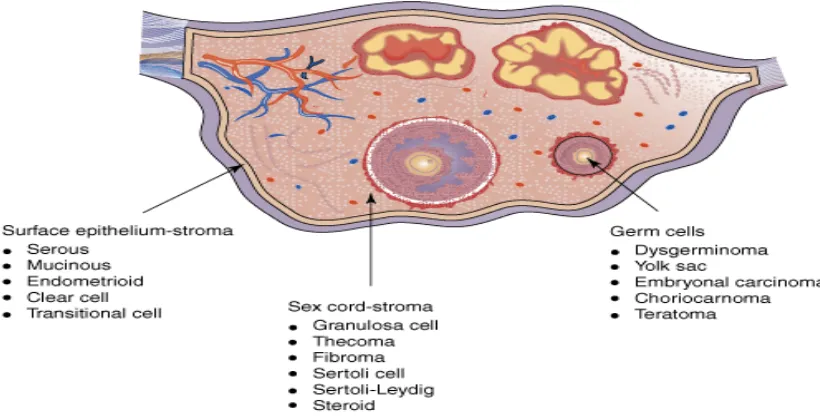 Gambar 1. Jenis histologi kanker ovarium 