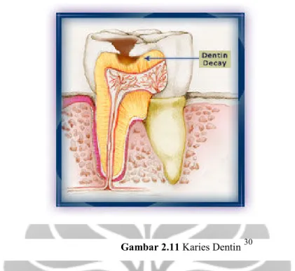 Gambar 2.11 Karies Dentin 30 