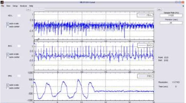 Gambar 4.2.:    Contoh data hasil akuisisi SigView untuk interval 25 detik. Berurutan dari atas adalah grafik data suara jantung (HSL), elektrisitas jantung (EKG), dan tekanan tidal pernafasan (PRS)
