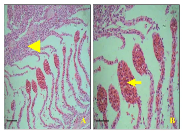 Gambar 4 Fusi lamela sekunder dengan infiltrasi sel radang (Kepala panah A).  