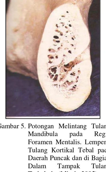 Gambar 5. Potongan Melintang Tulang Mandibula pada Regio Foramen Mentalis. Lempeng Tulang Kortikal Tebal pada Daerah Puncak dan di Bagian Dalam Tampak Tulang Trabekula  (Misch, 2005) 