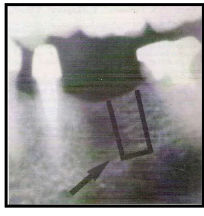 Gambar 8. Pola Trabekula Tulang Grade 3 (Taguchi, 1997) 