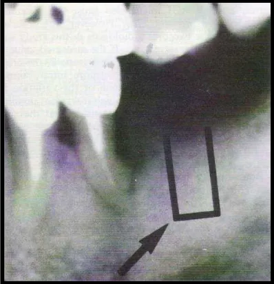 Gambar 10. Pola Trabekula Tulang Grade 5 (Taguchi, 1997) 