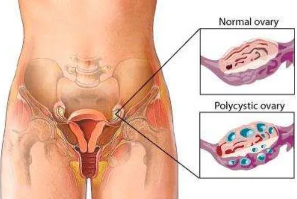 Gambar 2.9 Polycystic Ovary 