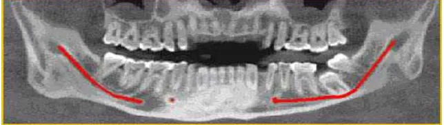 Gambar 6. Contoh radiograf kanalis mandibularis 16 
