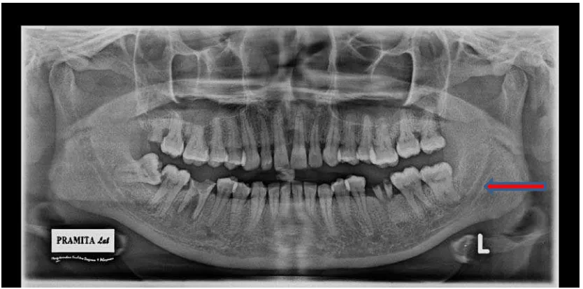 Gambar 8. Gambaran radiografi panoramik kanalis mandibularis kiri yang normal 